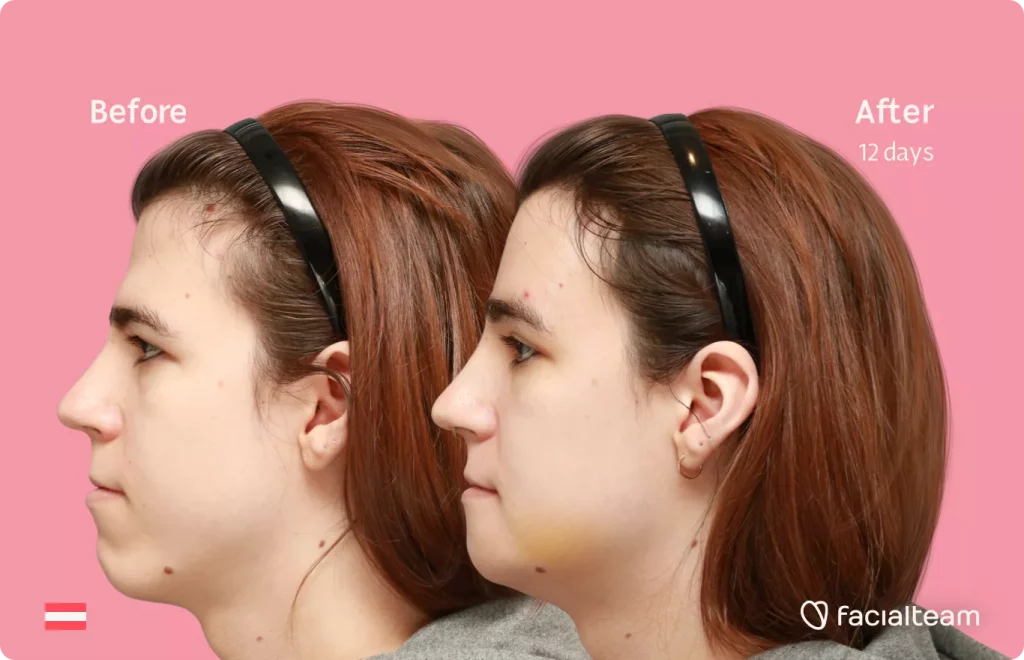 Side image of FFS patient Emma H showing the results before and after facial feminization surgery with Facialteam consisting of forehead and chin feminization.