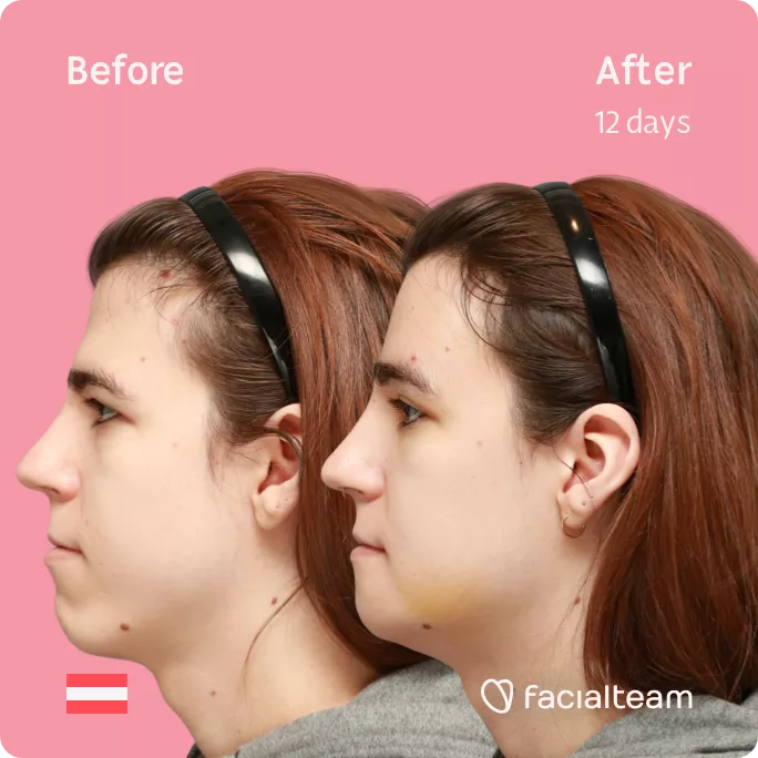 Square side image of FFS patient Emma H showing the results before and after facial feminization surgery with Facialteam consisting of forehead and chin feminization.