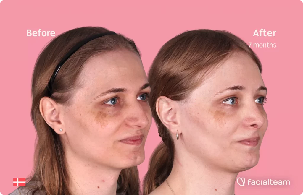 45 degree angle image of FFS patient Thea showing the results before and after facial feminization surgery with Facialteam consisting of forehead, rhinoplasty, jaw and chin feminization.