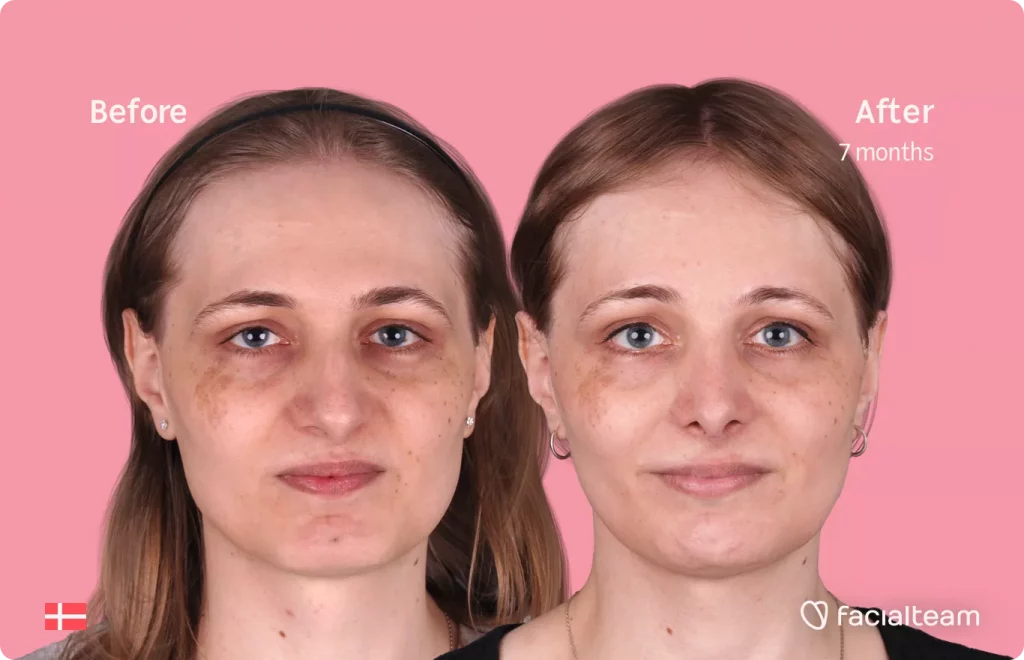 Frontal image of FFS patient Thea showing the results before and after facial feminization surgery with Facialteam consisting of forehead, rhinoplasty, jaw and chin feminization.