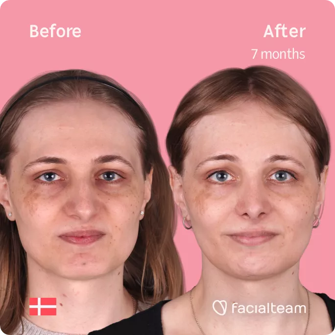Square frontal image of FFS patient Thea showing the results before and after facial feminization surgery with Facialteam consisting of forehead, rhinoplasty, jaw and chin feminization.