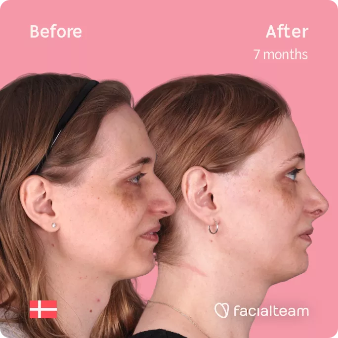 Square side image of FFS patient Thea showing the results before and after facial feminization surgery with Facialteam consisting of forehead, rhinoplasty, jaw and chin feminization.