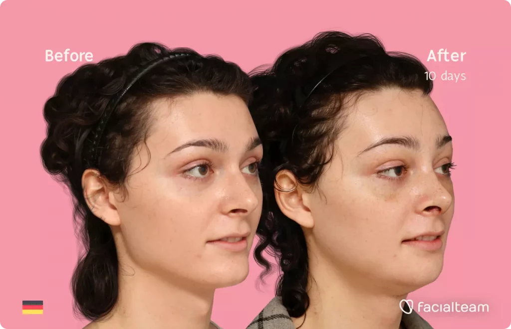 45 degree angle image of FFS patient April showing the results before and after facial feminization surgery with Facialteam consisting of forehead, rhinoplasty, tracheal shave, jaw and chin feminization.