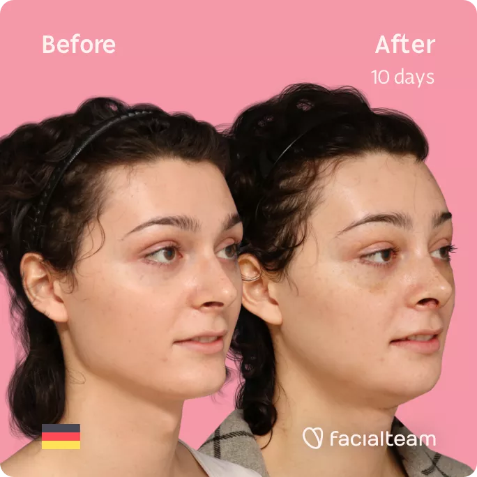 Square 45 degree angle image of FFS patient April showing the results before and after facial feminization surgery with Facialteam consisting of forehead, rhinoplasty, tracheal shave, jaw and chin feminization.
