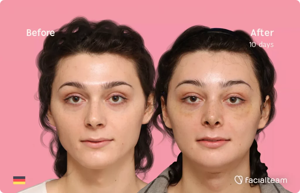 Frontal image of FFS patient April showing the results before and after facial feminization surgery with Facialteam consisting of forehead, rhinoplasty, tracheal shave, jaw and chin feminization.