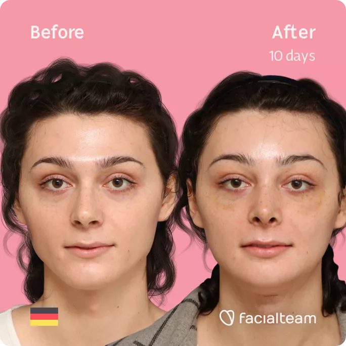 Square frontal image of FFS patient April showing the results before and after facial feminization surgery with Facialteam consisting of forehead, rhinoplasty, tracheal shave, jaw and chin feminization.