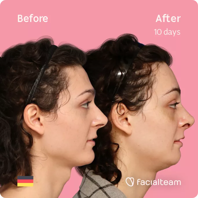 Square side image of FFS patient April showing the results before and after facial feminization surgery with Facialteam consisting of forehead, rhinoplasty, tracheal shave, jaw and chin feminization.