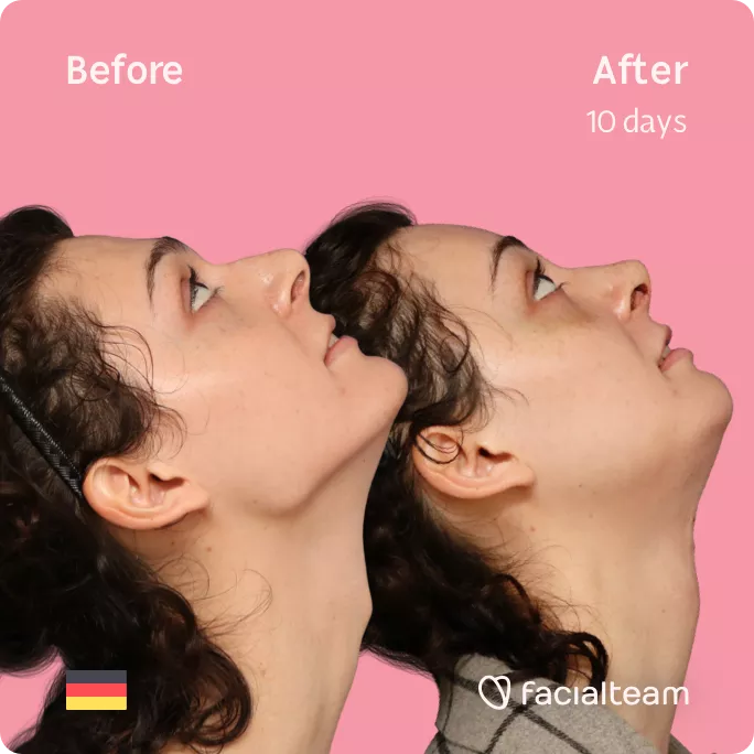 Square side up image of FFS patient April showing the results before and after facial feminization surgery with Facialteam consisting of forehead, rhinoplasty, tracheal shave, jaw and chin feminization.