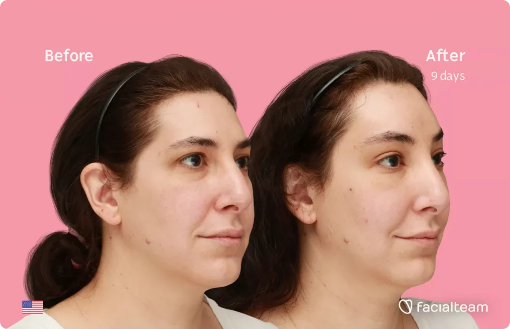 45 degree angle image of FFS patient Bridget showing the results before and after facial feminization surgery with Facialteam consisting of forehead feminization.