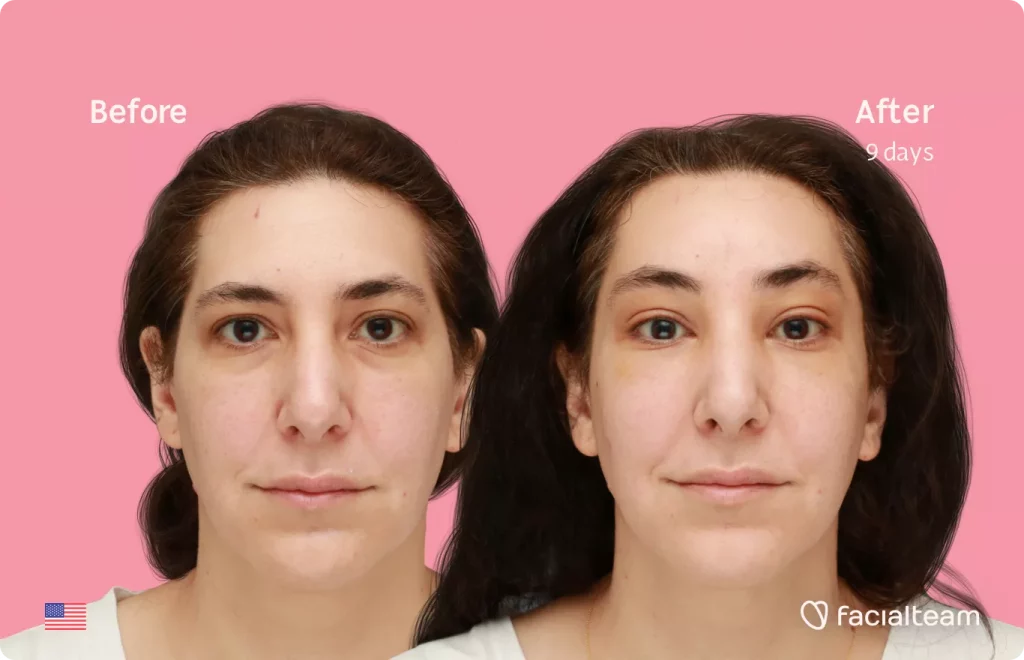 Frontal image of FFS patient Bridget showing the results before and after facial feminization surgery with Facialteam consisting of forehead feminization.