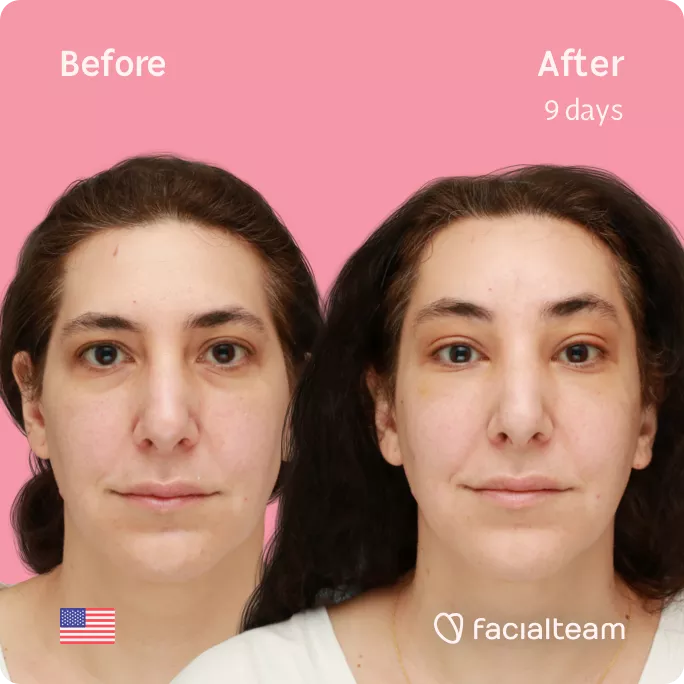 Square frontal image of FFS patient Bridget showing the results before and after facial feminization surgery with Facialteam consisting of forehead feminization.