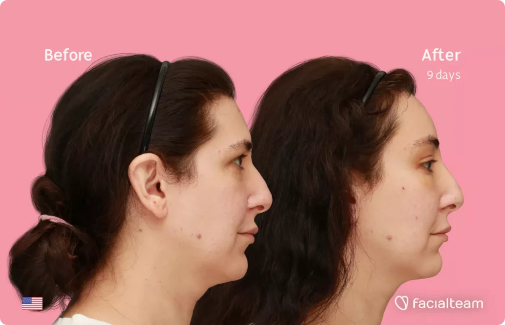 Side image of FFS patient Bridget showing the results before and after facial feminization surgery with Facialteam consisting of forehead feminization.