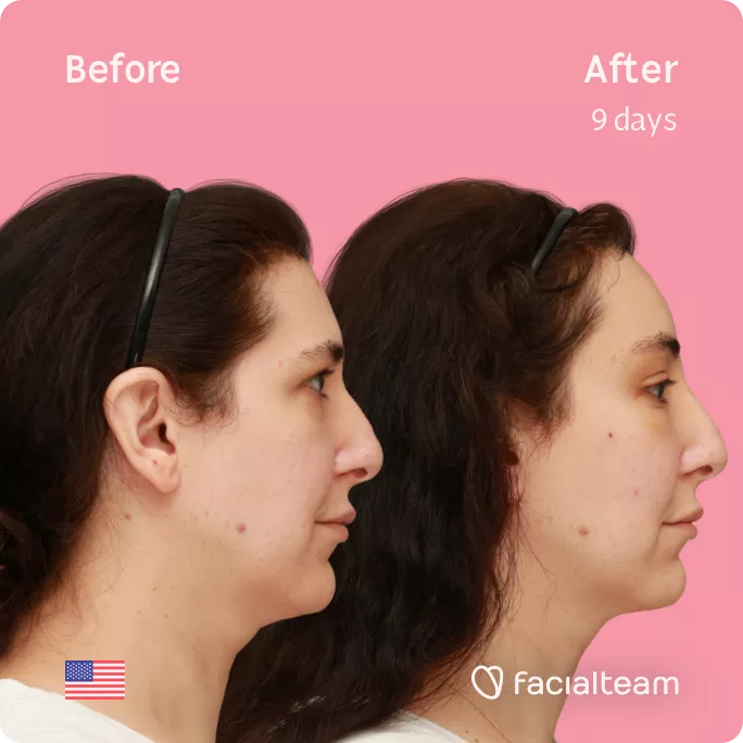 Square side image of FFS patient Bridget showing the results before and after facial feminization surgery with Facialteam consisting of forehead feminization.