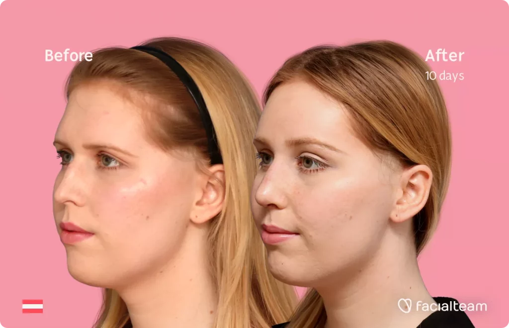 45 degree left angle image of FFS patient Sarah M showing the results before and after facial feminization surgery with Facialteam consisting of forehead feminization and rhinoplasty.