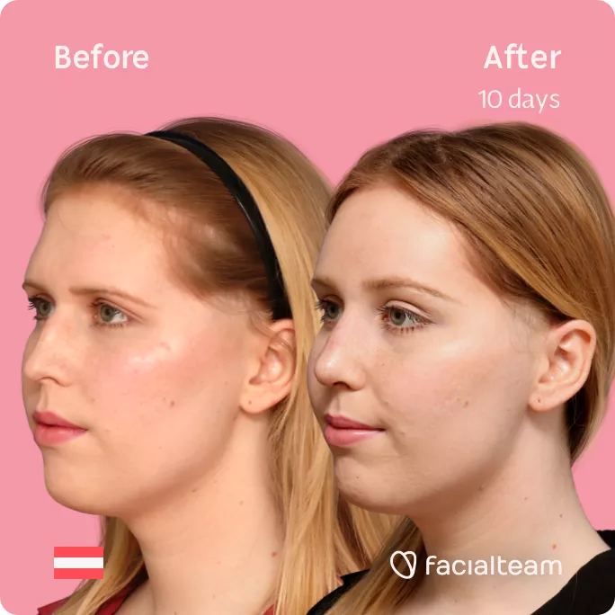 Square 45 degree left angle image of FFS patient Sarah M showing the results before and after facial feminization surgery with Facialteam consisting of forehead feminization and rhinoplasty.
