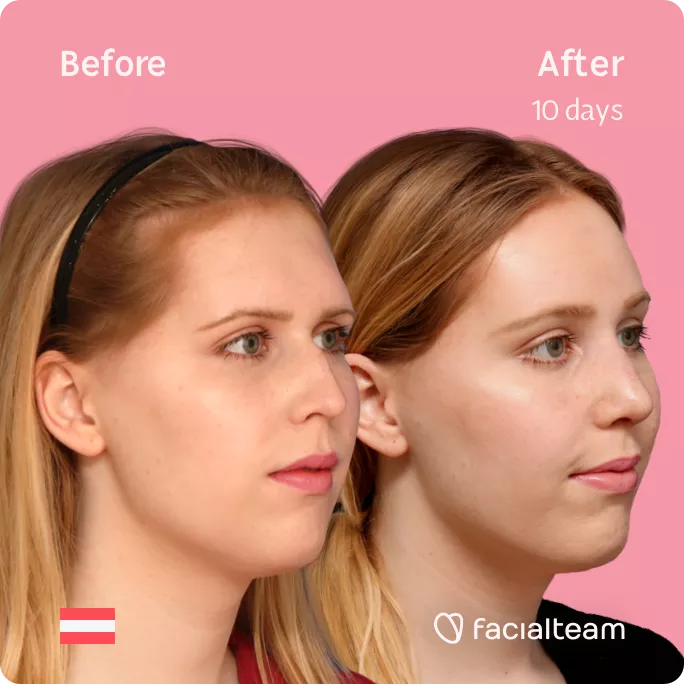 Square 45 degree right angle image of FFS patient Sarah M showing the results before and after facial feminization surgery with Facialteam consisting of forehead feminization and rhinoplasty.