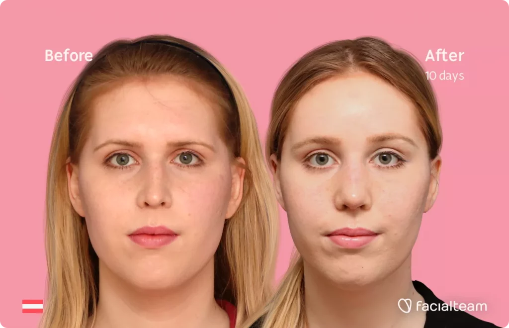 Frontal image of FFS patient Sarah M showing the results before and after facial feminization surgery with Facialteam consisting of forehead feminization and rhinoplasty.