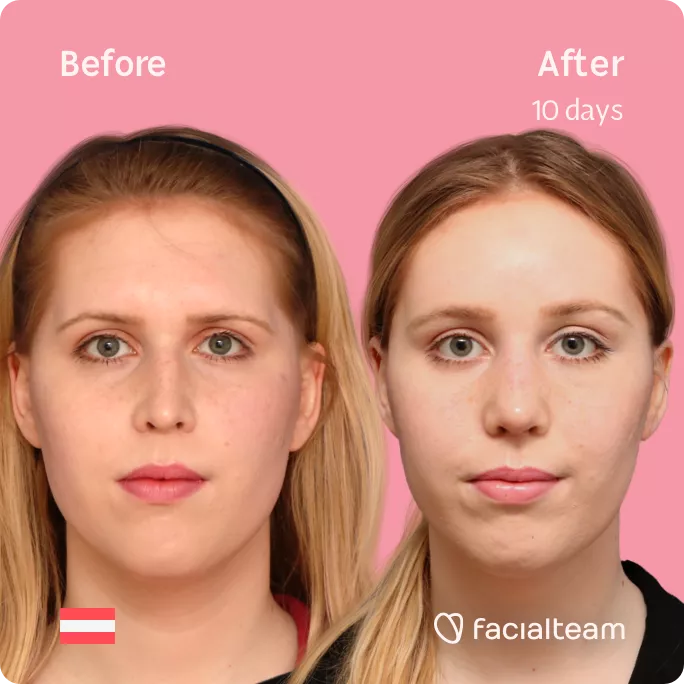 Square frontal image of FFS patient Sarah M showing the results before and after facial feminization surgery with Facialteam consisting of forehead feminization and rhinoplasty.