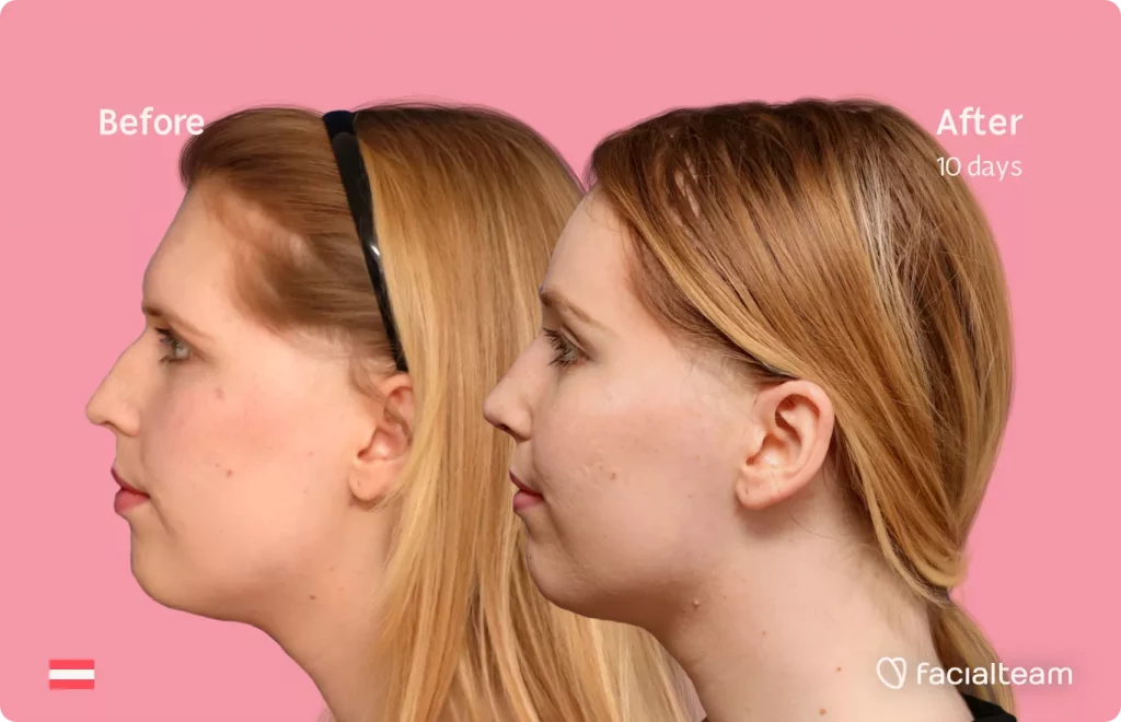 Left side image of FFS patient Sarah M showing the results before and after facial feminization surgery with Facialteam consisting of forehead feminization and rhinoplasty.