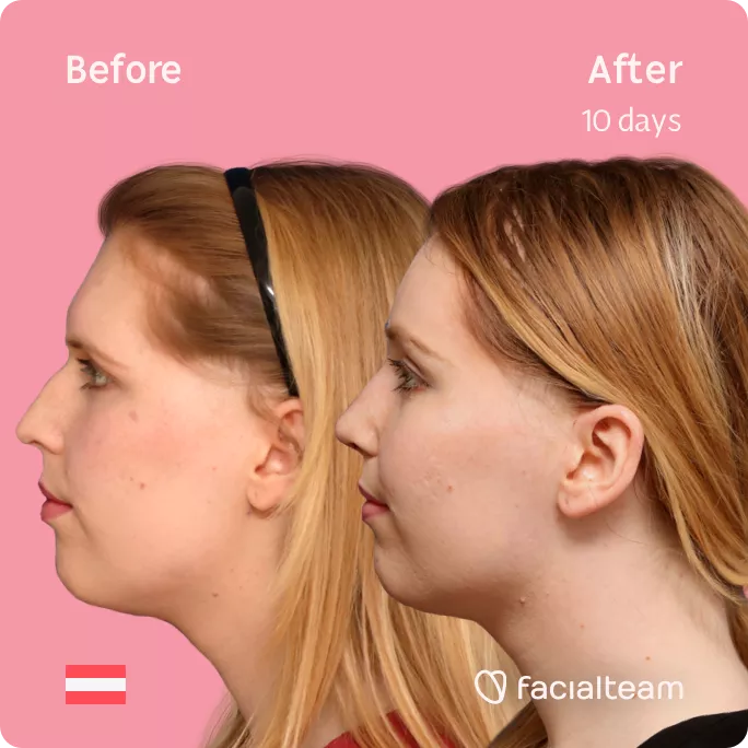 Square left side image of FFS patient Sarah M showing the results before and after facial feminization surgery with Facialteam consisting of forehead feminization and rhinoplasty.