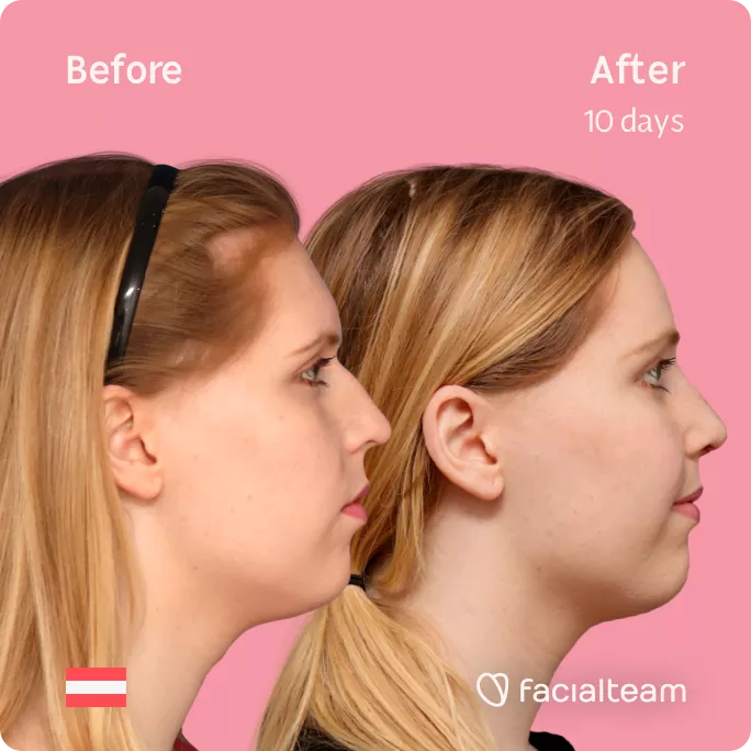 Square right side image of FFS patient Sarah M showing the results before and after facial feminization surgery with Facialteam consisting of forehead feminization and rhinoplasty.