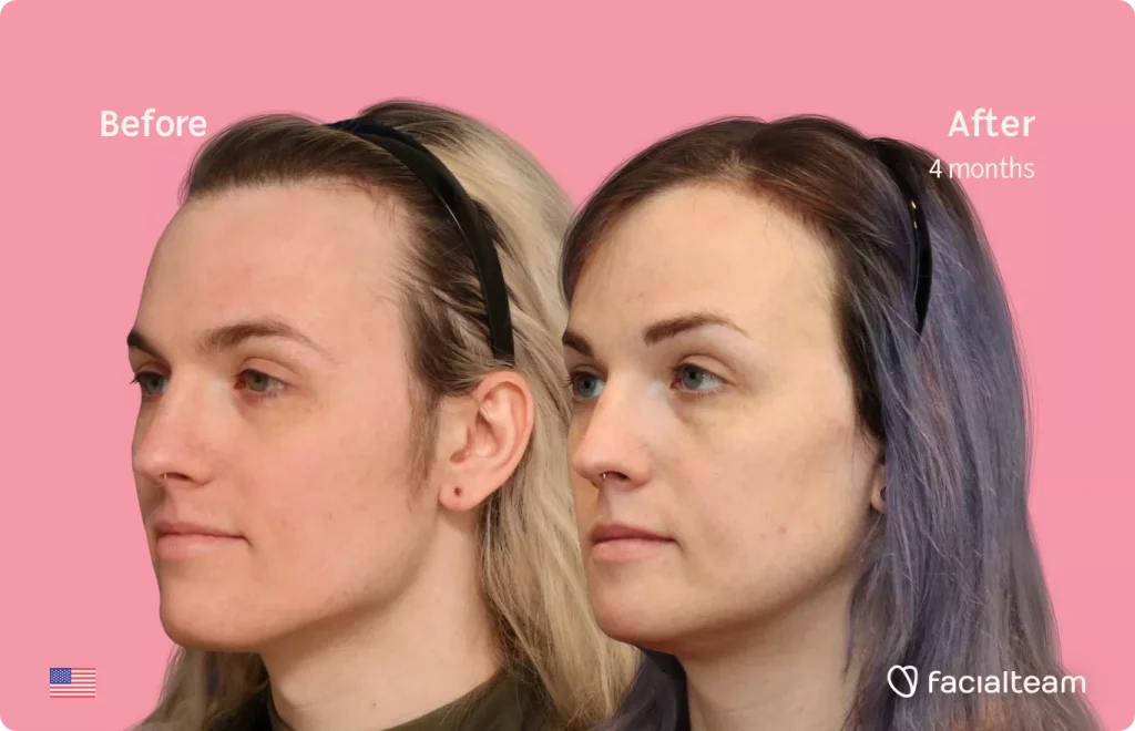 45 degree left angle image of FFS patient Lauren P showing the results before and after facial feminization surgery with Facialteam consisting of forehead with SHT, jaw and chin feminization.
