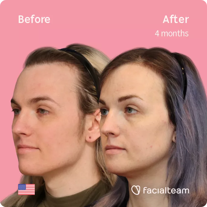 Square 45 degree left angle image of FFS patient Lauren P showing the results before and after facial feminization surgery with Facialteam consisting of forehead with SHT, jaw and chin feminization.