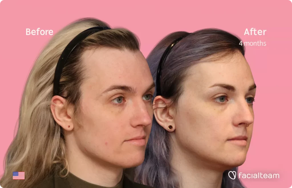 45 degree right angle image of FFS patient Lauren P showing the results before and after facial feminization surgery with Facialteam consisting of forehead with SHT, jaw and chin feminization.