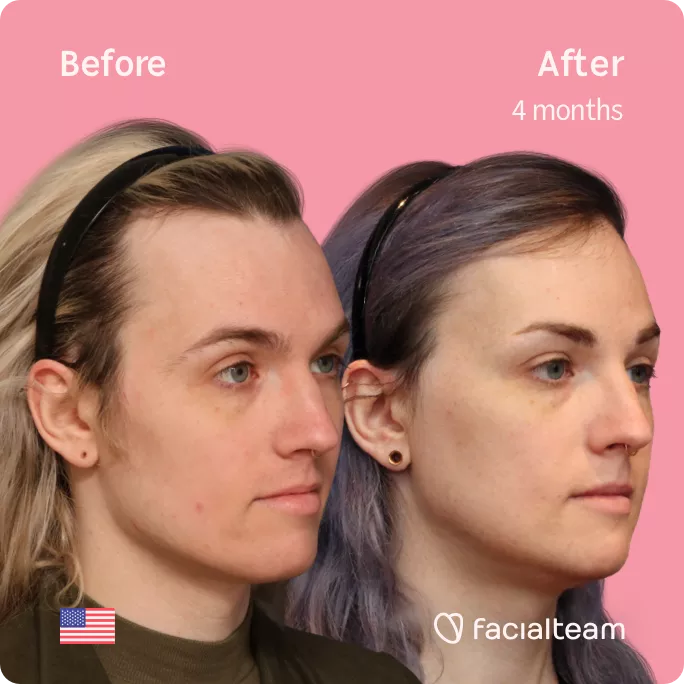 Square 45 degree right angle image of FFS patient Lauren P showing the results before and after facial feminization surgery with Facialteam consisting of forehead with SHT, jaw and chin feminization.