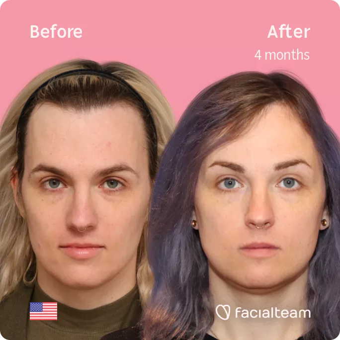 Square frontal image of FFS patient Lauren P showing the results before and after facial feminization surgery with Facialteam consisting of forehead with SHT, jaw and chin feminization.