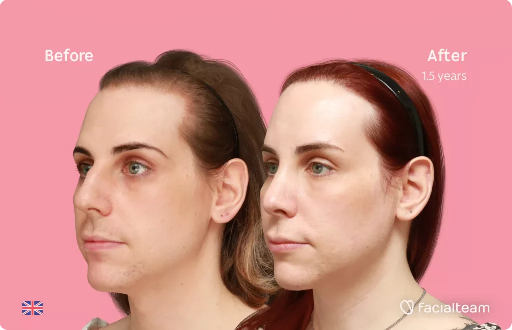 45 degree angle image of FFS patient Katelyn showing the results before and after facial feminization surgery with Facialteam consisting of forehead feminization with SHT and rhinoplasty.
