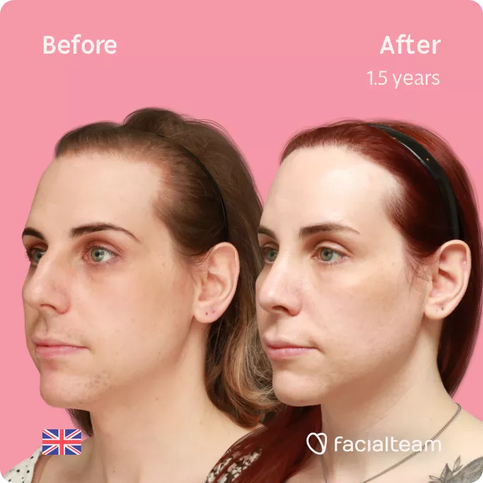 Square 45 degree angle image of FFS patient Katelyn showing the results before and after facial feminization surgery with Facialteam consisting of forehead feminization with SHT and rhinoplasty.