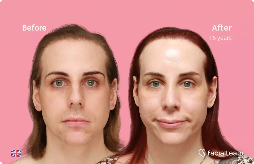 Frontal image of FFS patient Katelyn showing the results before and after facial feminization surgery with Facialteam consisting of forehead feminization with SHT and rhinoplasty.