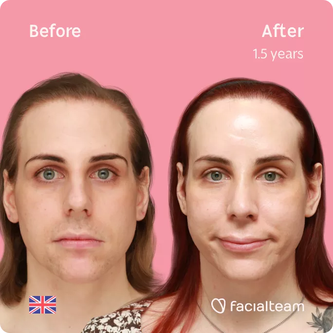 Square frontal image of FFS patient Katelyn showing the results before and after facial feminization surgery with Facialteam consisting of forehead feminization with SHT and rhinoplasty.