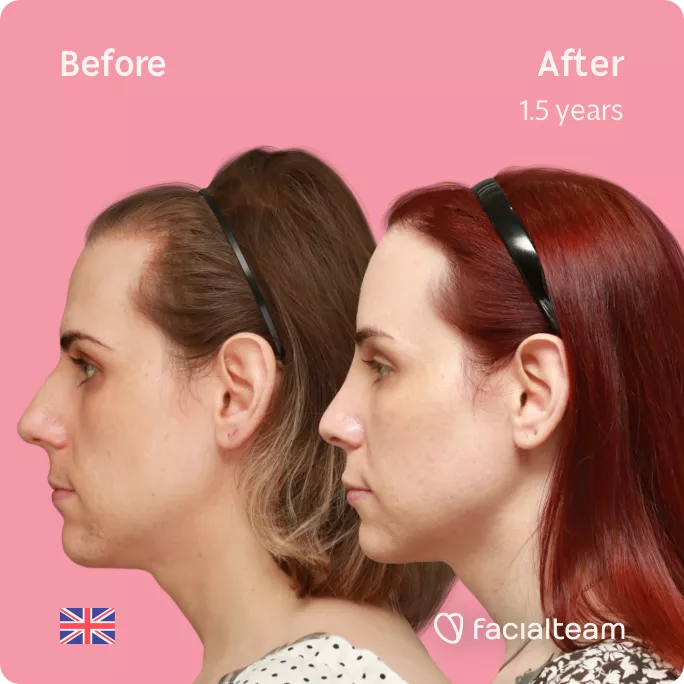 Square side image of FFS patient Katelyn showing the results before and after facial feminization surgery with Facialteam consisting of forehead feminization with SHT and rhinoplasty.