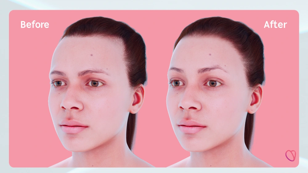 Facialteam FOREContour® 3D method image showing a before and after surgery