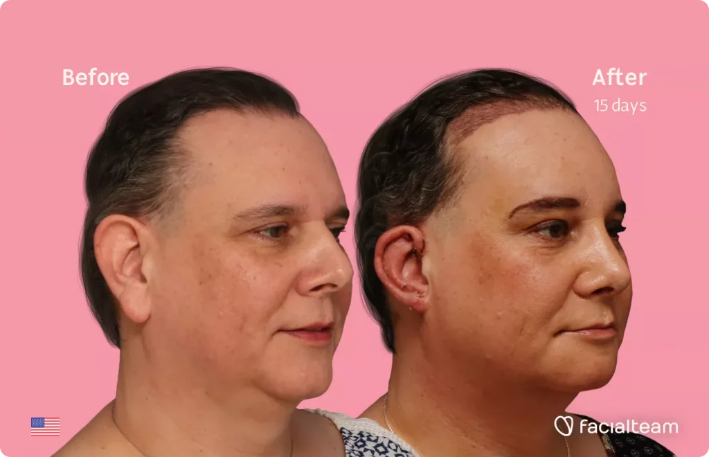 45 degree angle image of FFS patient Davida showing the results before and after facial feminization surgery with Facialteam consisting of forehead feminization with SHT, rhinoplasty and chin feminization.