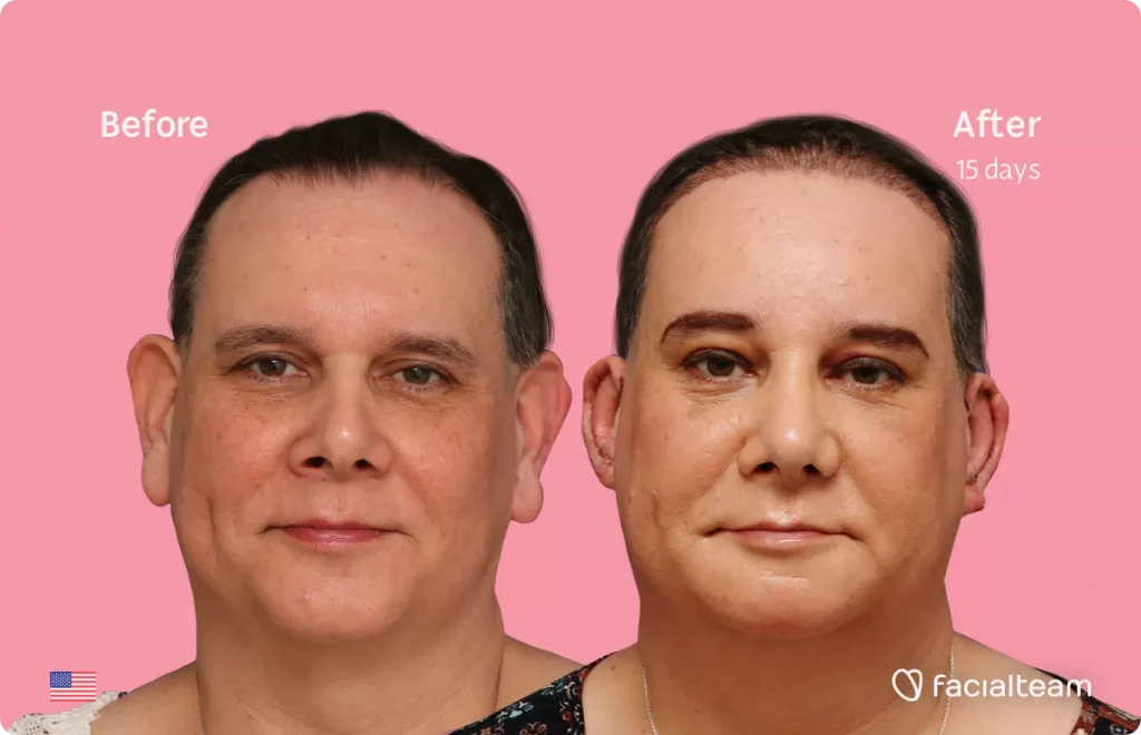 Frontal image of FFS patient Davida showing the results before and after facial feminization surgery with Facialteam consisting of forehead feminization with SHT, rhinoplasty and chin feminization.