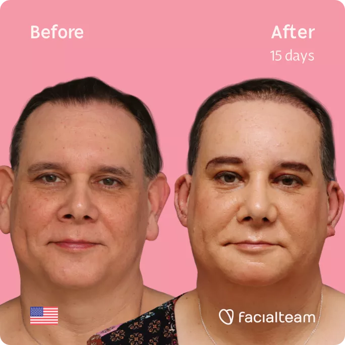 Square frontal image of FFS patient Davida showing the results before and after facial feminization surgery with Facialteam consisting of forehead feminization with SHT, rhinoplasty and chin feminization.