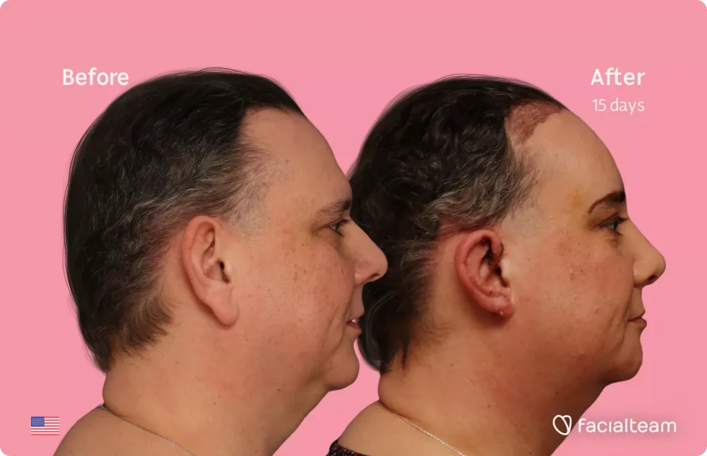 Side image of FFS patient Davida showing the results before and after facial feminization surgery with Facialteam consisting of forehead feminization with SHT, rhinoplasty and chin feminization.