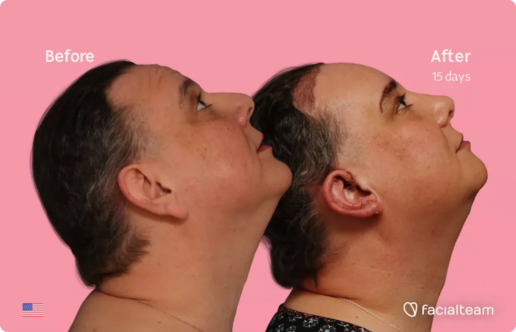 Side up image of FFS patient Davida showing the results before and after facial feminization surgery with Facialteam consisting of forehead feminization with SHT, rhinoplasty and chin feminization.
