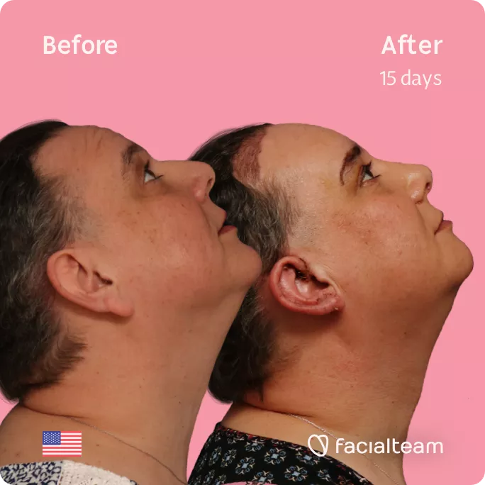 Square side up image of FFS patient Davida showing the results before and after facial feminization surgery with Facialteam consisting of forehead feminization with SHT, rhinoplasty and chin feminization.