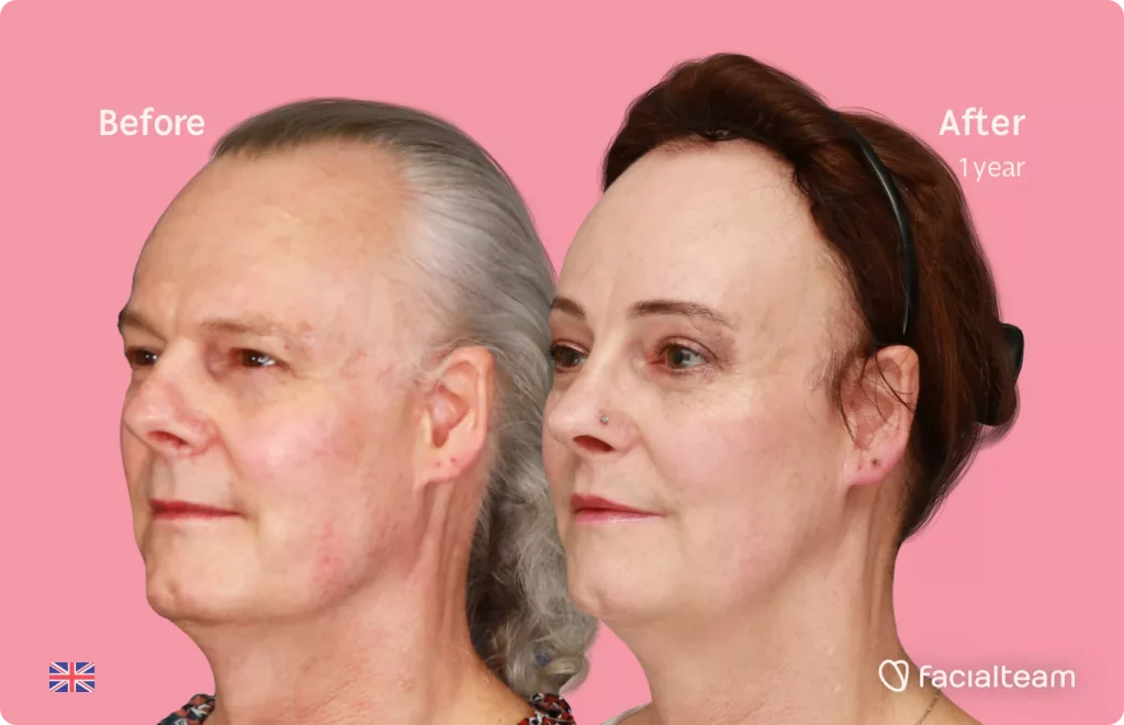 45 degree left angle image of FFS patient Deena showing the results before and after facial feminization surgery with Facialteam consisting of forehead feminization with SHT, jaw and chin feminization, rhinoplasty and tracheal shave.