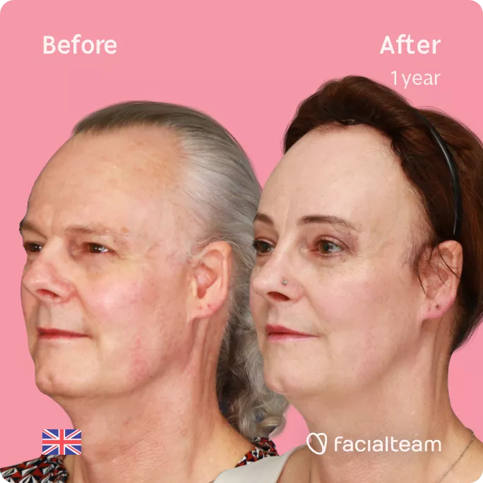 Square 45 degree left angle image of FFS patient Deena showing the results before and after facial feminization surgery with Facialteam consisting of forehead feminization with SHT, jaw and chin feminization, rhinoplasty and tracheal shave.