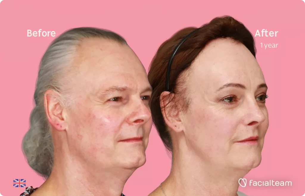 45 degree right angle image of FFS patient Deena showing the results before and after facial feminization surgery with Facialteam consisting of forehead feminization with SHT, jaw and chin feminization, rhinoplasty and tracheal shave.