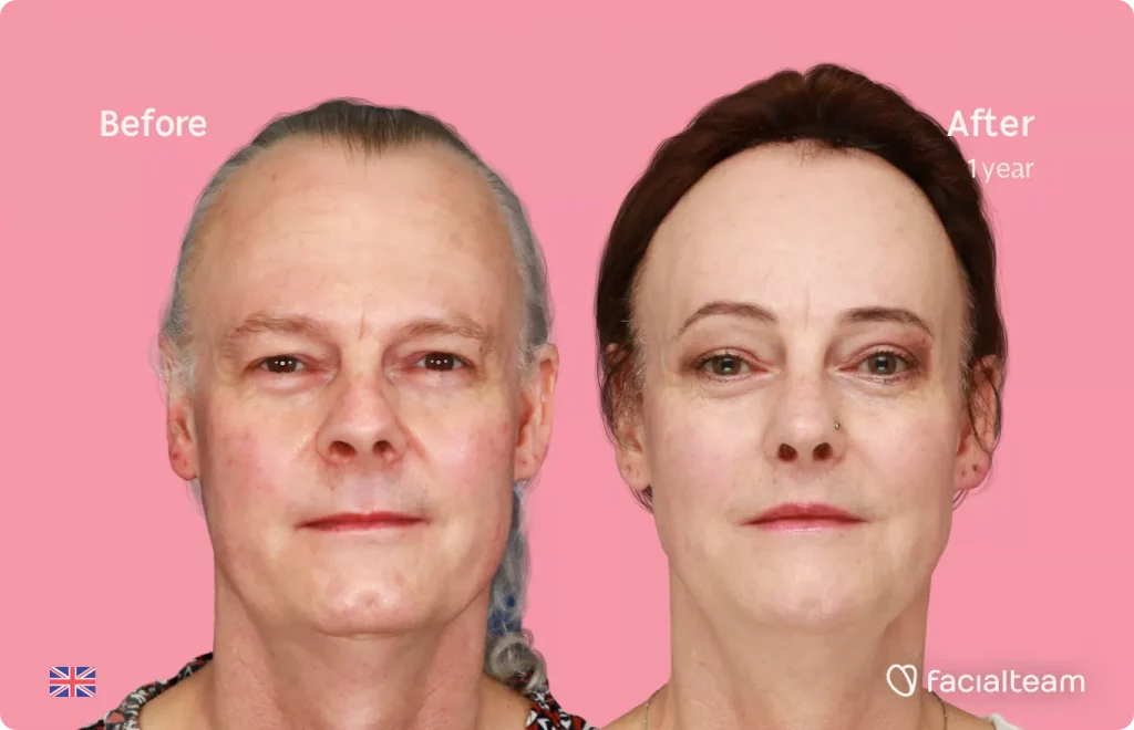 Frontal image of FFS patient Deena showing the results before and after facial feminization surgery with Facialteam consisting of forehead feminization with SHT, jaw and chin feminization, rhinoplasty and tracheal shave.