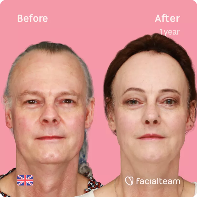 Square frontal image of FFS patient Deena showing the results before and after facial feminization surgery with Facialteam consisting of forehead feminization with SHT, jaw and chin feminization, rhinoplasty and tracheal shave.