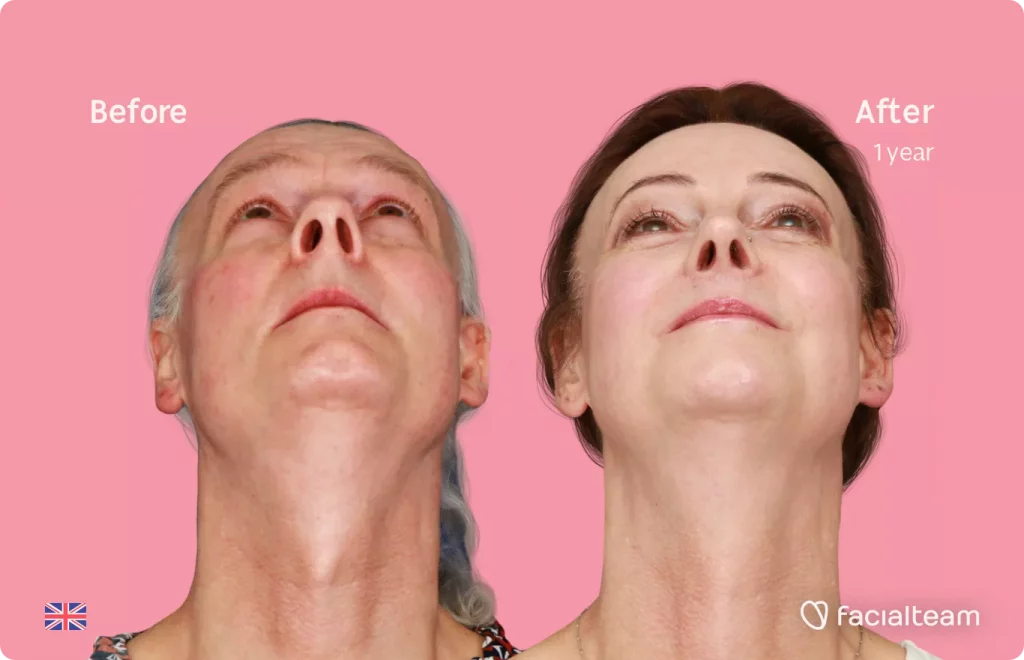 Frontal up image of FFS patient Deena showing the results before and after facial feminization surgery with Facialteam consisting of forehead feminization with SHT, jaw and chin feminization, rhinoplasty and tracheal shave.