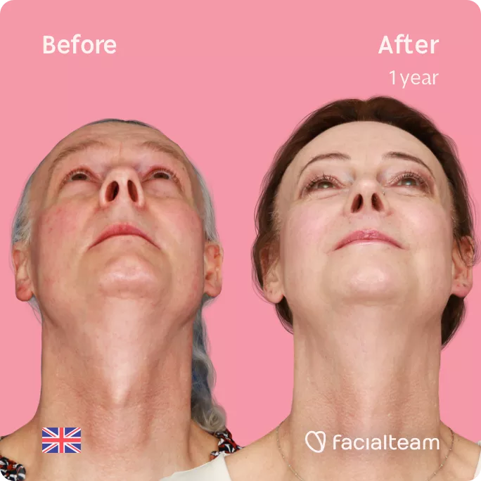 Square frontal up image of FFS patient Deena showing the results before and after facial feminization surgery with Facialteam consisting of forehead feminization with SHT, jaw and chin feminization, rhinoplasty and tracheal shave.