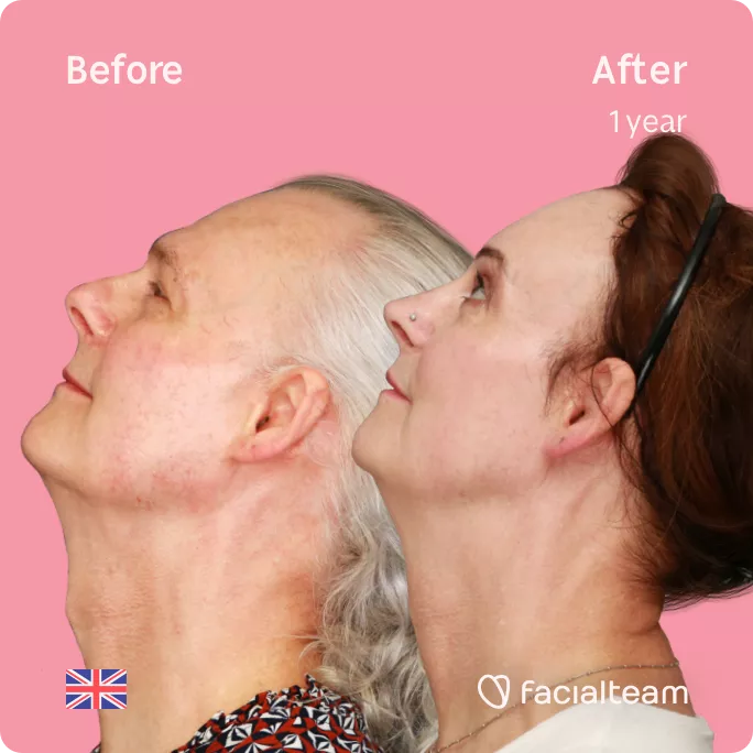 Square left side up image of FFS patient Deena showing the results before and after facial feminization surgery with Facialteam consisting of forehead feminization with SHT, jaw and chin feminization, rhinoplasty and tracheal shave.